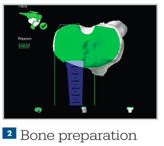 bone preparation