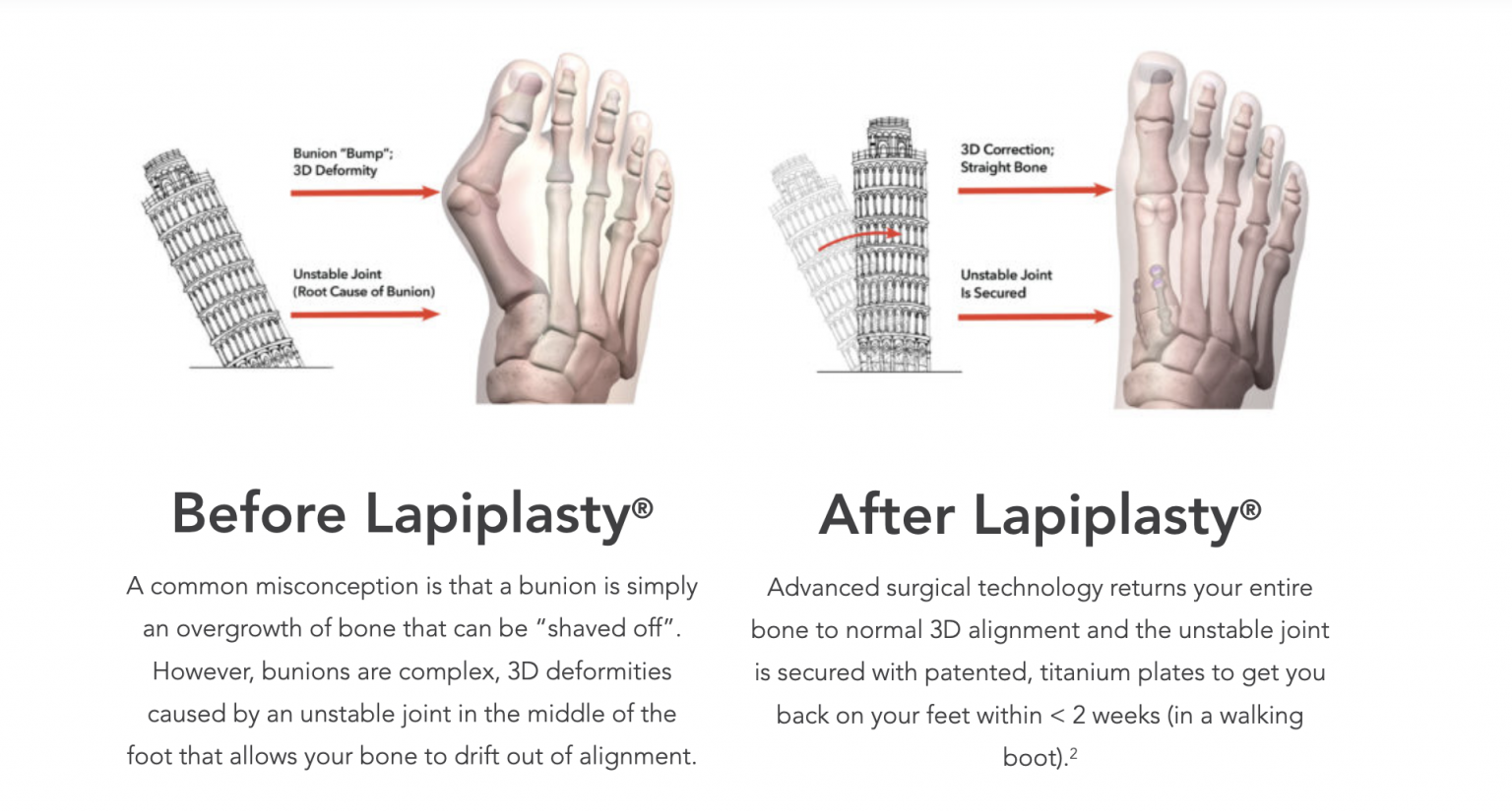 Lapiplasty® 3D Bunion Correction™ With Dr. Gregory Rouw - St. Cloud ...